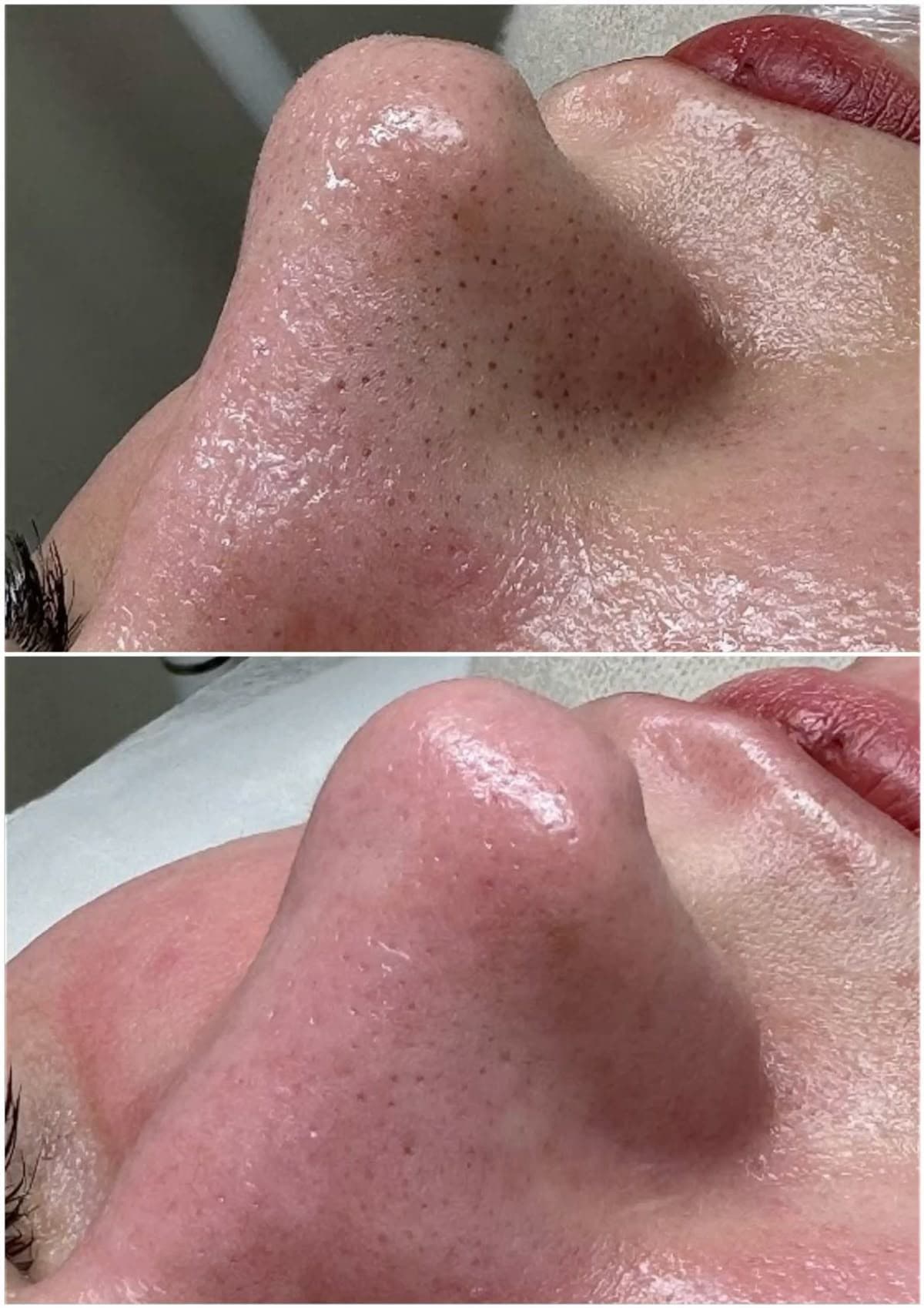 Dermaplaning Facial before and after