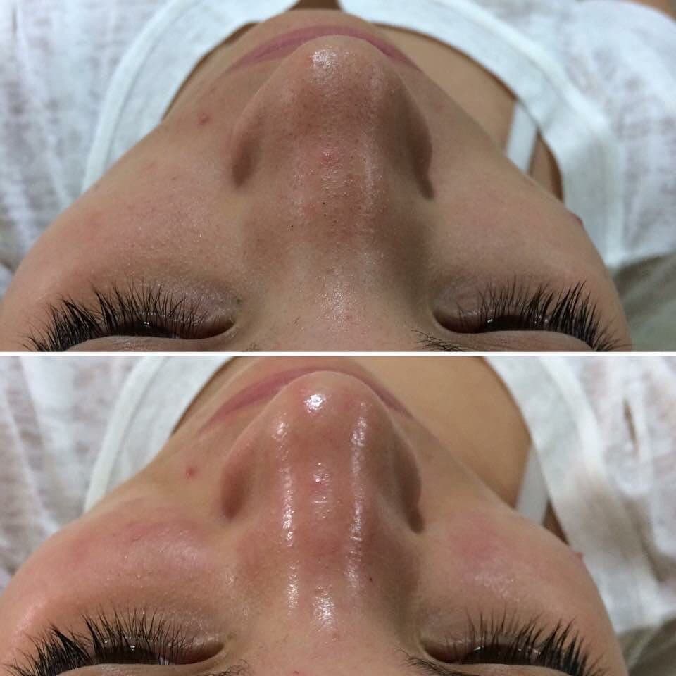 Glow Facial before and after