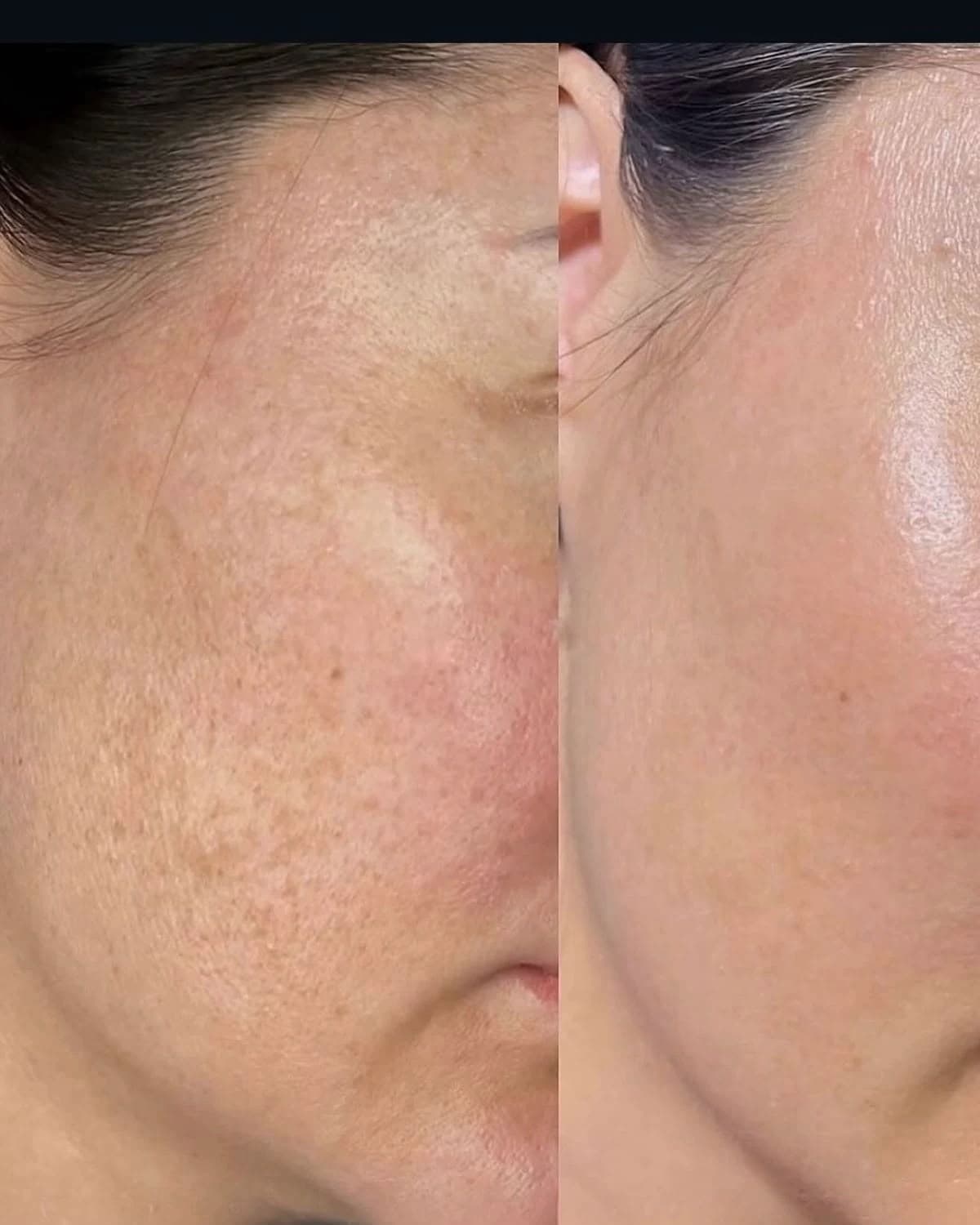 LED Light Facial before and after